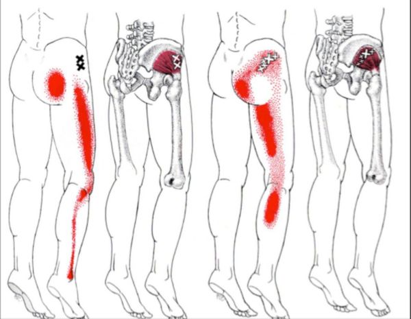 Why Does My Sciatic Nerve Hurt?