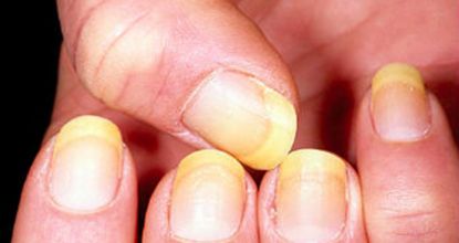 How Your Body Warns You That Dementia Is Forming