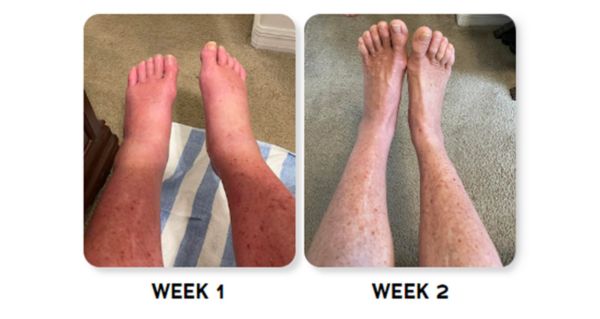 How Seniors Get Rid Of Swollen Feet (In As Little As 4 Days)