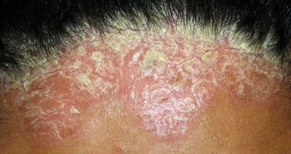 DO NOT SCRATCH: How To Treat Scalp Psoriasis
