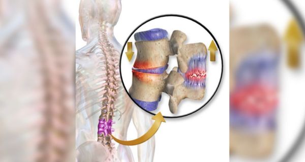 Spine Surgeon: #1 Vitamin for Searing Sciatic Nerve Pain